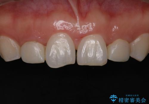 歯の形気になる!! セラミック治療 前歯( エクセレント)の治療前
