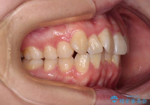 【モニター】八重歯を片側の抜歯矯正で治す メタルブラケット装置の治療前