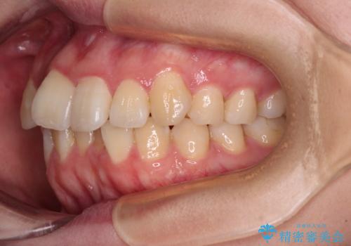 【モニター】八重歯を片側の抜歯矯正で治す メタルブラケット装置の治療前