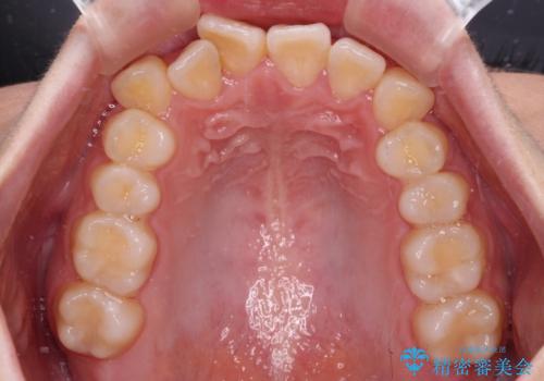 【モニター】八重歯を片側の抜歯矯正で治す メタルブラケット装置の治療前