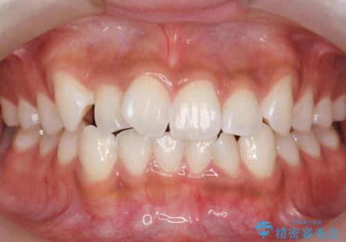 前歯のがたつき　1年かからず治療　マウスピース矯正の症例 治療前