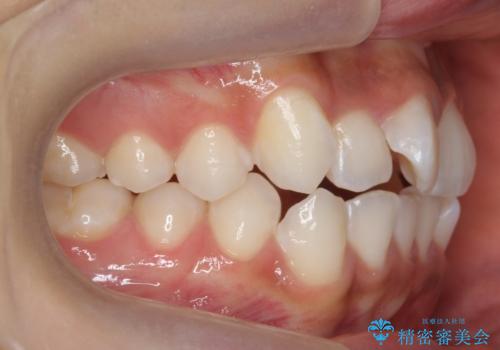 前歯のがたつき　1年かからず治療　マウスピース矯正の治療前