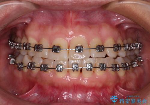 骨格のずれをカムフラージュ クロスバイトのワイヤー矯正の治療中