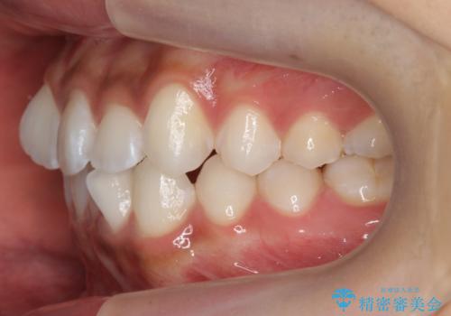 前歯のがたつき 1年かからず治療 マウスピース矯正の治療前