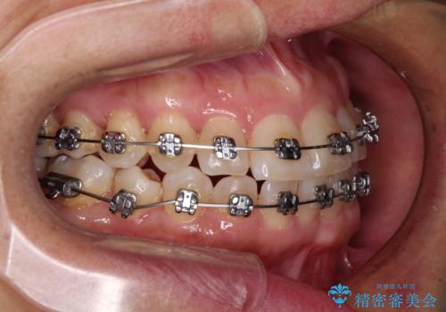 骨格のずれをカムフラージュ クロスバイトのワイヤー矯正の治療中
