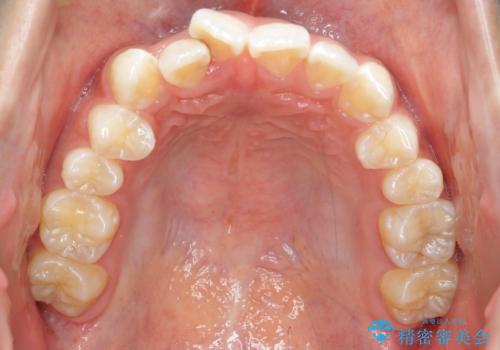 前歯のがたつき 1年かからず治療 マウスピース矯正の治療前