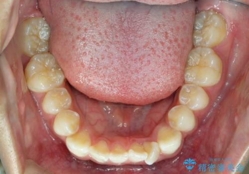 前歯のがたつき 1年かからず治療 マウスピース矯正の治療前