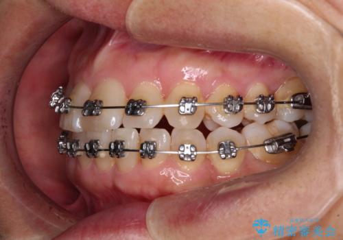 骨格のずれをカムフラージュ クロスバイトのワイヤー矯正の治療中