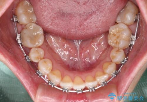 骨格のずれをカムフラージュ クロスバイトのワイヤー矯正の治療中