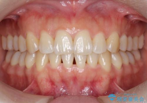 下の前歯のがたつき インビザラインでの治療後