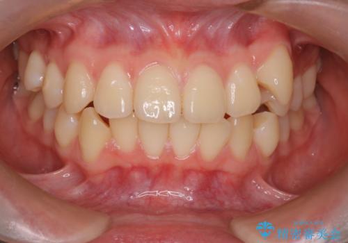 【インビザライン 抜歯ケース】八重歯をなおしたい。の治療前