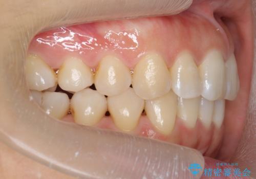 下の前歯のがたつき インビザラインでの治療後