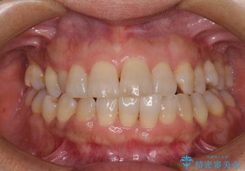 骨格のずれをカムフラージュ クロスバイトのワイヤー矯正の症例 治療前