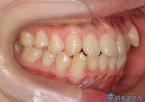 【インビザライン】八重歯をなおしたい。抜歯ケースの治療前