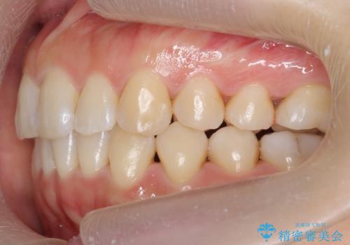 下の前歯のがたつき インビザラインでの治療後