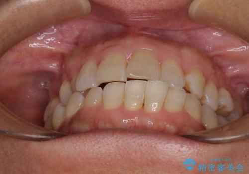 骨格のずれをカムフラージュ クロスバイトのワイヤー矯正の治療前