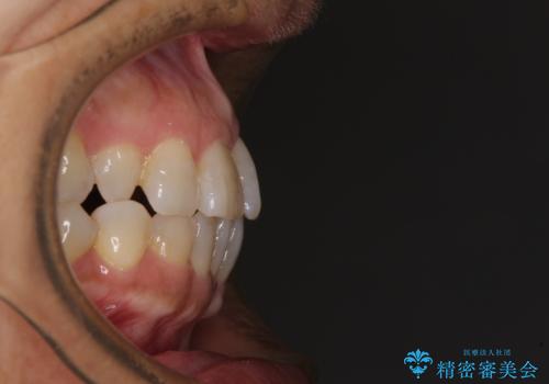 骨格のずれをカムフラージュ クロスバイトのワイヤー矯正の治療前