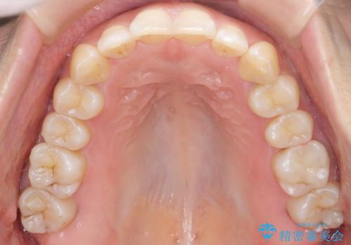 下の前歯のがたつき インビザラインでの治療後