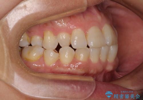 骨格のずれをカムフラージュ クロスバイトのワイヤー矯正の治療前