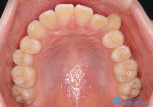 【インビザライン 抜歯ケース】八重歯をなおしたい。の治療前