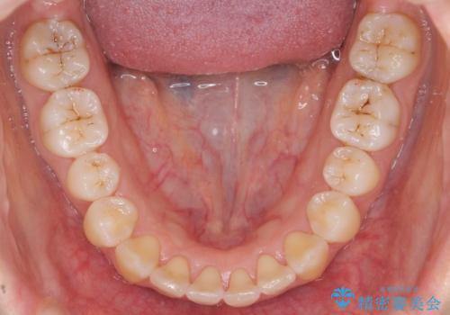 下の前歯のがたつき インビザラインでの症例 治療後
