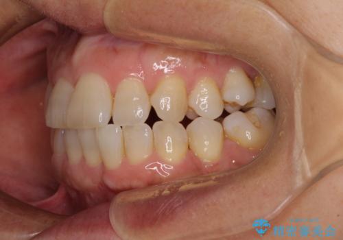 骨格のずれをカムフラージュ クロスバイトのワイヤー矯正の治療前