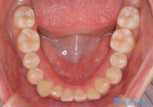 【インビザライン 抜歯ケース】八重歯をなおしたい。の治療前