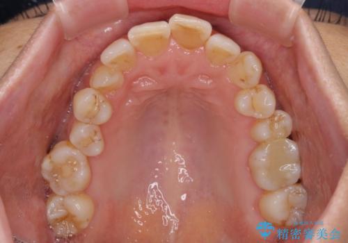 骨格のずれをカムフラージュ クロスバイトのワイヤー矯正の治療前