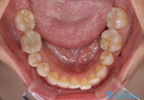 骨格のずれをカムフラージュ クロスバイトのワイヤー矯正の治療前