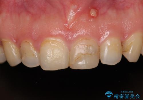 つぎはぎだらけの前歯をオールセラミッククラウンで自然な前歯にの症例 治療前