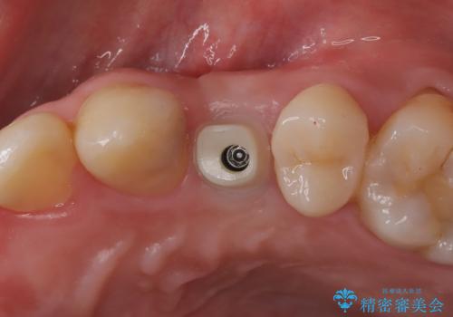 【インプラント】歯が無いので入れて欲しい!の治療中