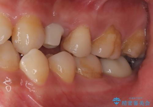 【インプラント】歯が無いので入れて欲しい!の治療中