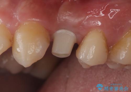 【インプラント】歯が無いので入れて欲しい!の治療中