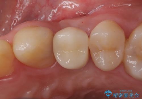 【インプラント】歯が無いので入れて欲しい!の症例 治療後