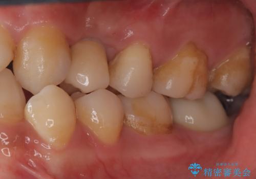 【インプラント】歯が無いので入れて欲しい!の治療後