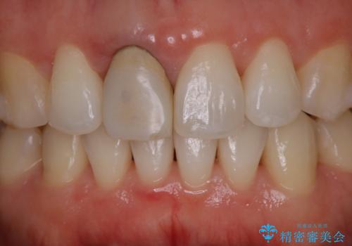 前歯の色が気になる オールセラミッククラウン(SP)の治療前