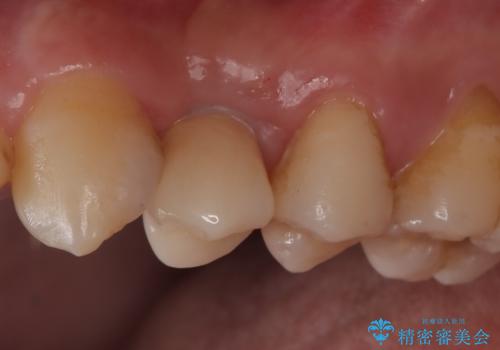 【インプラント】歯が無いので入れて欲しい!の治療後