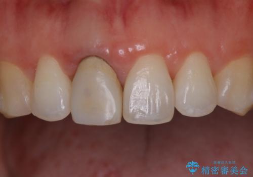 前歯の色が気になる オールセラミッククラウン(SP)の治療前