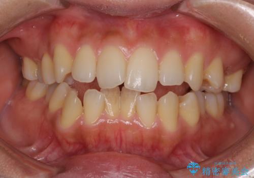 残存乳歯とオープンバイト　インビザラインによる矯正治療の症例 治療前