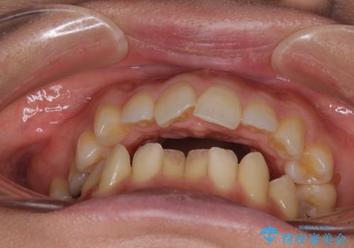 残存乳歯とオープンバイト インビザラインによる矯正治療の治療前