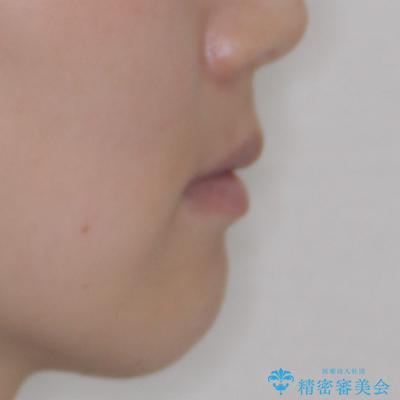 閉じにくい口元を抜歯矯正ですっきりとの治療後(顔貌)