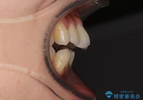 残存乳歯とオープンバイト インビザラインによる矯正治療の治療前