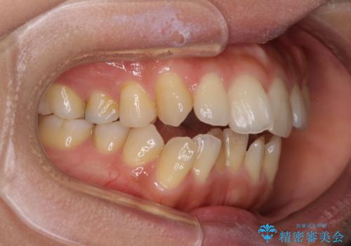 残存乳歯とオープンバイト　インビザラインによる矯正治療の治療前