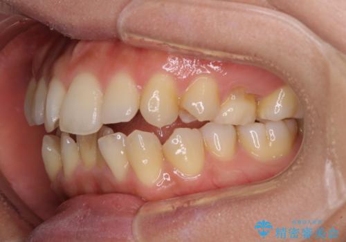 残存乳歯とオープンバイト　インビザラインによる矯正治療の治療前