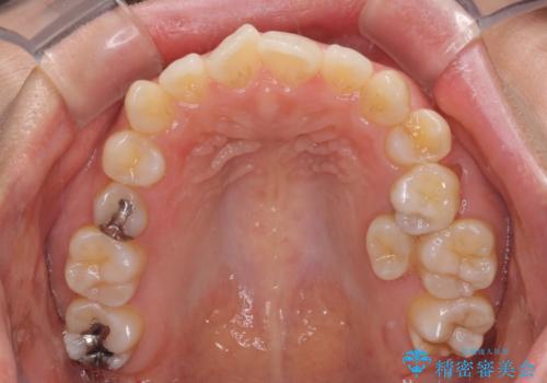 残存乳歯とオープンバイト インビザラインによる矯正治療の治療前