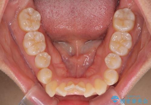 残存乳歯とオープンバイト インビザラインによる矯正治療の治療前