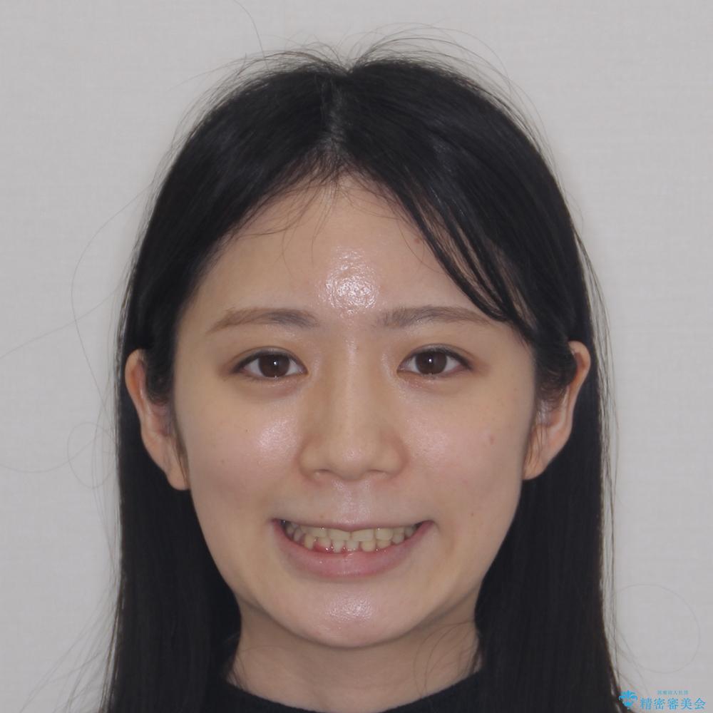 【モニター】再矯正でデコボコの前歯を改善 抜歯矯正の後戻りの治療後(顔貌)