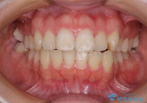 口元の突出感を抜歯矯正で改善　メタル装置で費用を抑えるの症例 治療前