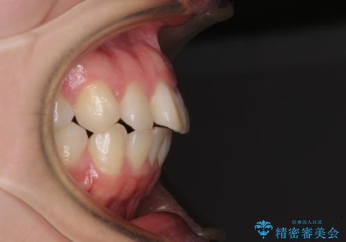 口元の突出感を抜歯矯正で改善　メタル装置で費用を抑えるの治療前
