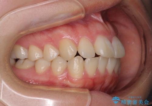 口元の突出感を抜歯矯正で改善 メタル装置で費用を抑えるの治療前